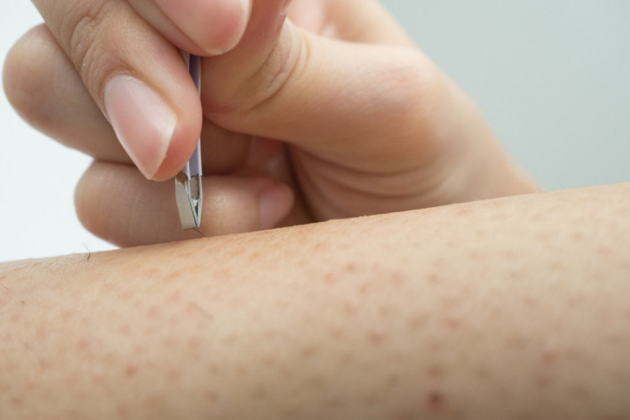 Urasla DLAČICA na telu može da dovede do OPERACIJE: Doktor otkriva TRIK zahvaljujući kome nikada nećete imati PROBLEM!