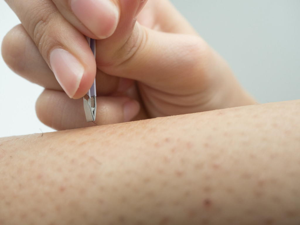 Dermatolozi su pronašli IDEALNO rešenje: Košta oko 200 dinara, a URASLE dlačice će nestati