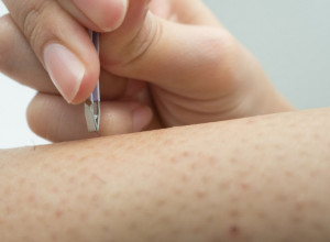 Dermatolozi su pronašli IDEALNO rešenje: Košta oko 200 dinara, a URASLE dlačice će nestati