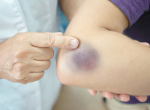 Na telu vam se pojavljuju MODRICE? Mnogo je uzroka, ali jedan je PRAVI RAZLOG za brigu