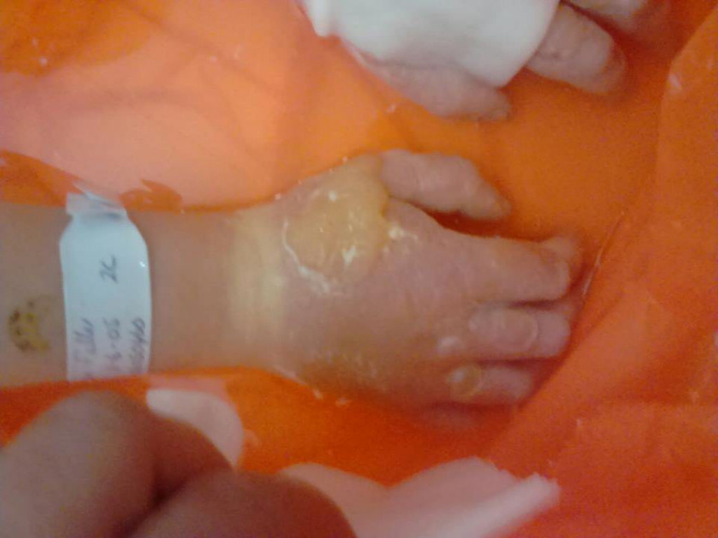 Devojčica (4) zadobila UŽASNE opekotine: Dodirnula je ovu OPASNU biljku koja izgleda kao KOROV i raste u DVORIŠTIMA