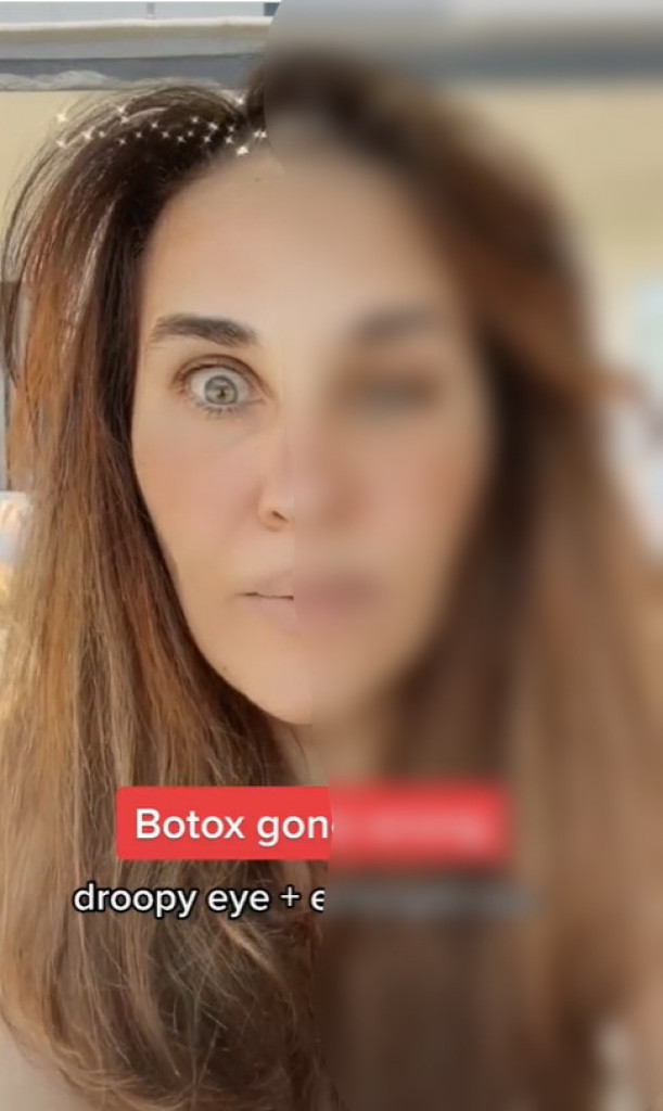 Pokazala je svoje lice posle BOTOKSA: Izgledalo je kao da je preživela MOŽDANI UDAR, deca na ulici su bežala od nje!