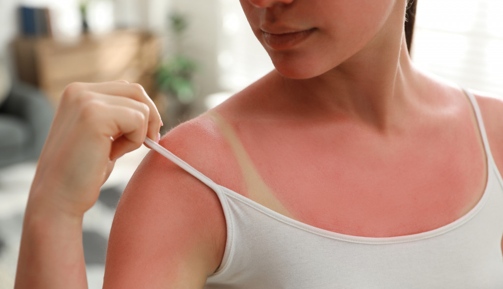 "Izgorela sam na suncu, a svekrvin trik me spasio za pola sata": Fora je u jednom proizvodu koji svi imamo kod kuće, a nije kiselo mleko