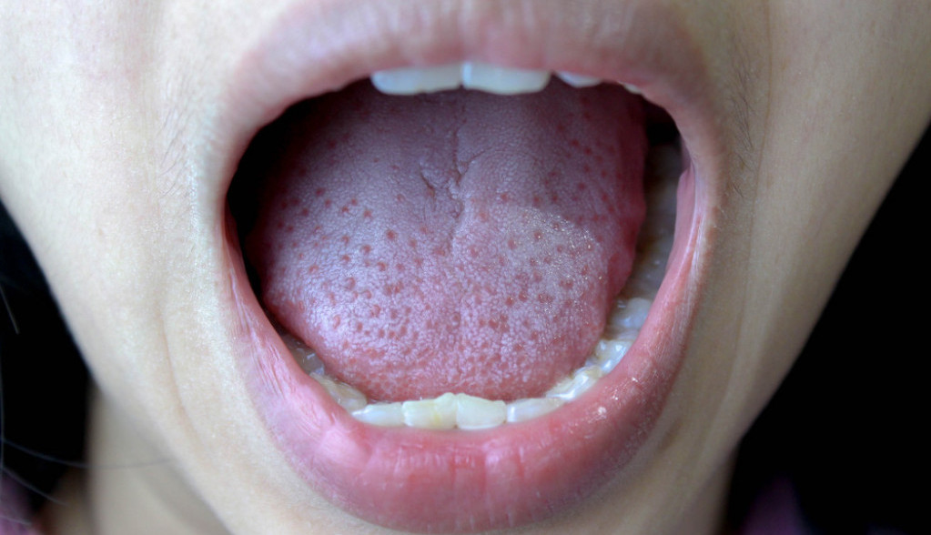 Znak na JEZIKU koji može da vas ZABRINE: Ako ovo vidite javite se doktoru