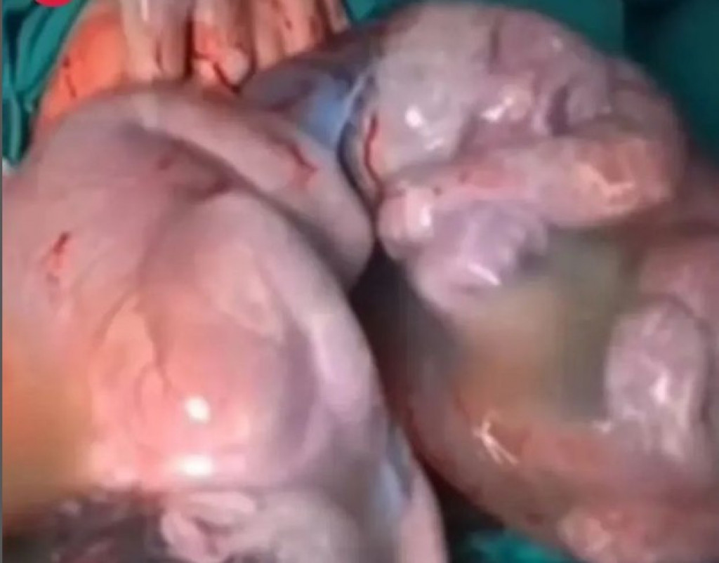 Svet gleda u ČUDU ovaj snimak: Doktor uspeo da SNIMI rađanje BLIZANACA, ovo se dešava JEDNOM u 80.000 slučajeva