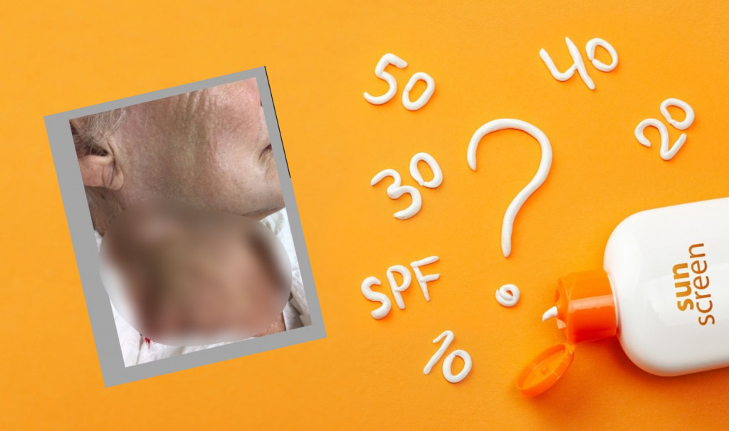 Jeziva fotografija ženinog vrata ŠOKIRALA svet: Evo šta se dešava kada ne koristite kremu za sunčanje!