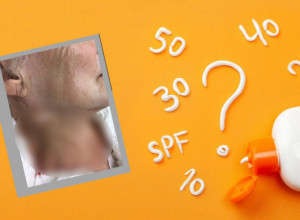 Jeziva fotografija ženinog vrata ŠOKIRALA svet: Evo šta se dešava kada ne koristite kremu za sunčanje!