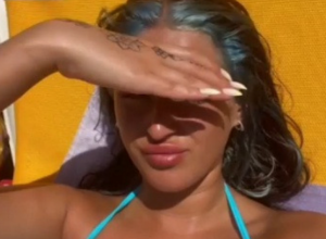 Odmor se pretvorio u pravi PAKAO: Devojka je napravila GREŠKU dok se sunčala, zbog OPEKOTINA imaće OŽILJAK do kraja života