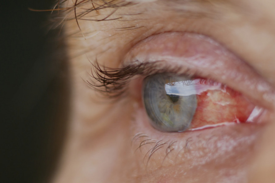 Izaziva povraćanje i jako KRVARENJE iz nosa: U ovom delu Evrope pojavio se opasan virus CCHF