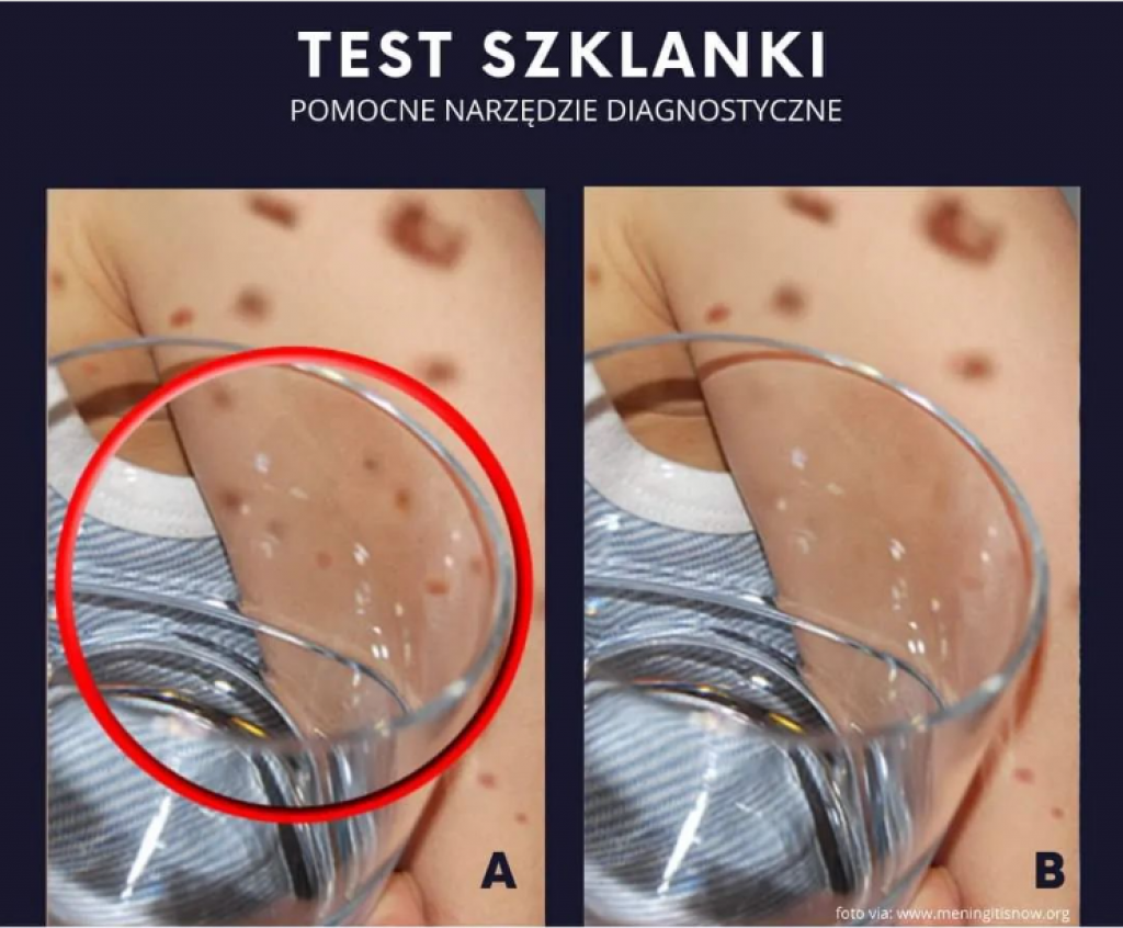 TEST SA ČAŠOM može da spasi život vašem DETETU: Mnogo dece UMIRE od ove opasne INFEKCIJE, ako primetite ovu promenu, odmah se uputite u BOLNICU