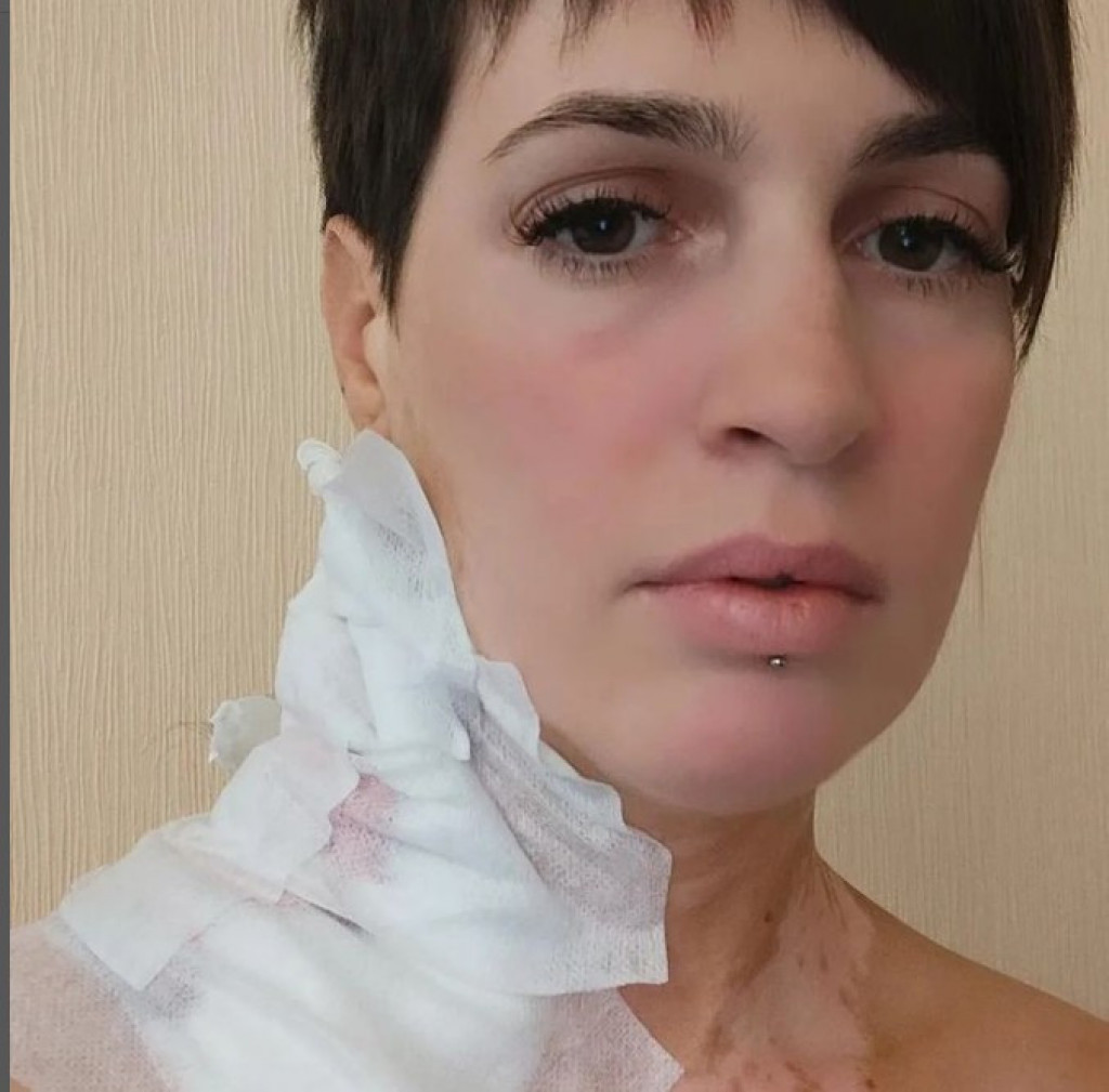 Katarina je zbog SOLARIJUMA dobila RAK KOŽE: Valjevčanka je do sada imala NEPOZNAT broj OPERACIJA, svaka je ostavila OŽILJAK, a njena borba još TRAJE