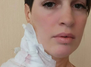Katarina je zbog SOLARIJUMA dobila RAK KOŽE: Valjevčanka je do sada imala NEPOZNAT broj OPERACIJA, svaka je ostavila OŽILJAK, a njena borba još TRAJE