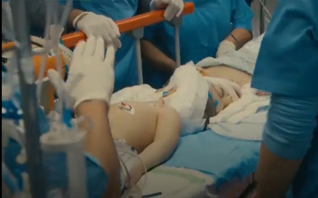 Glave su im bile SPOJENE: Nakon više od 25 sati na operacionom stolu, lekari su uspeli da razdvoje SIJAMSKE blizance (VIDEO)