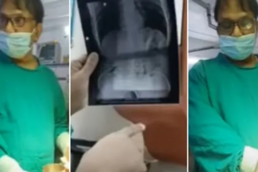 Gojaznim ljudima ovaj deo mozga je uvećan: Skener sve pokazao, ključan je za apetit, a od ove hrane se upali