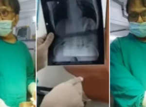 Otišao na jedno piće, pa završio na OPERACIONOM stolu: Lekari su mu pronašli metalnu čašu u ŽELUCU, sumnjaju da je OVO razlog