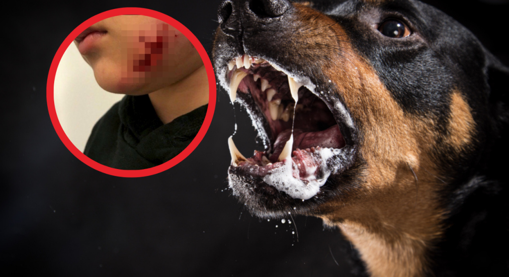 Devojčicu (7) rastrgao ROTVAJLER: Ostavio joj je DUBOKE rane na LICU,  a preživela je zahvaljujući KAPULJAČI na jakni (FOTO)