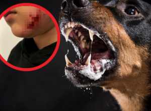 Devojčicu (7) rastrgao ROTVAJLER: Ostavio joj je DUBOKE rane na LICU,  a preživela je zahvaljujući KAPULJAČI na jakni (FOTO)