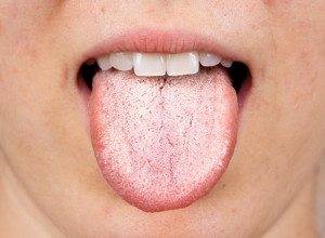 Jezik NIKADA ne sme ovako da izgleda: Ako primetite ovo, odmah se obratite lekaru, može ukazivati na BOLESTI