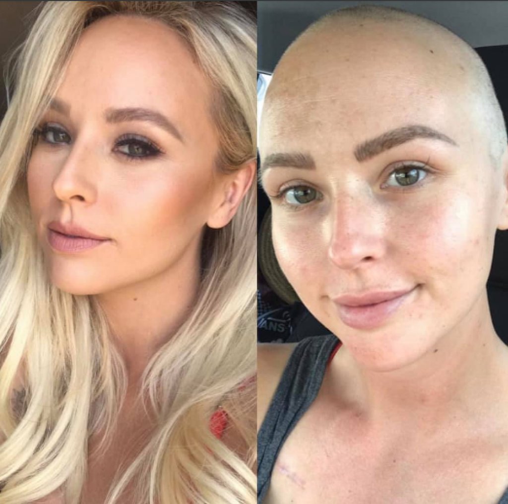 Greška LEKARA je umalo koštala ŽIVOTA: Odbili su da joj urade MAMOGRAFIJU jer je "premlada za rak", ubrzo je čula STRAŠNU dijagnozu!