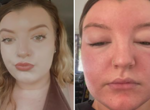 Nije obraćala pažnju na SIMPTOME, pa sutradan nije mogla OČI da otvori: Devojka pokazala POSLEDICE greške koju mnogi prave na suncu!