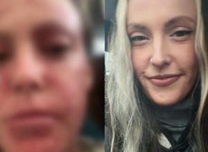 Prestala da koristi KREME za ekceme i lice joj se UNIŠTILO! Devojka pokazala PAKAO kroz koji prolazi - ljuštenje kože, bolovi... (FOTO)