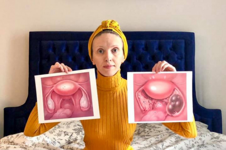 Borka je PRISTALA da joj izvade UNUTRAŠNJE organe: Otišla je kod lekara zbog BUBREGA, a dobila još STRAŠNIJU dijagnozu koju ima svaka deseta žena u Srbiji