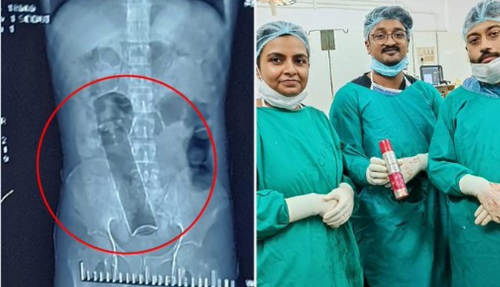 Dvadeset dana nije vršio NUŽDU: Primljen je u HITNU, a hirurzi su se frapirali kad su ga operisali (FOTO)