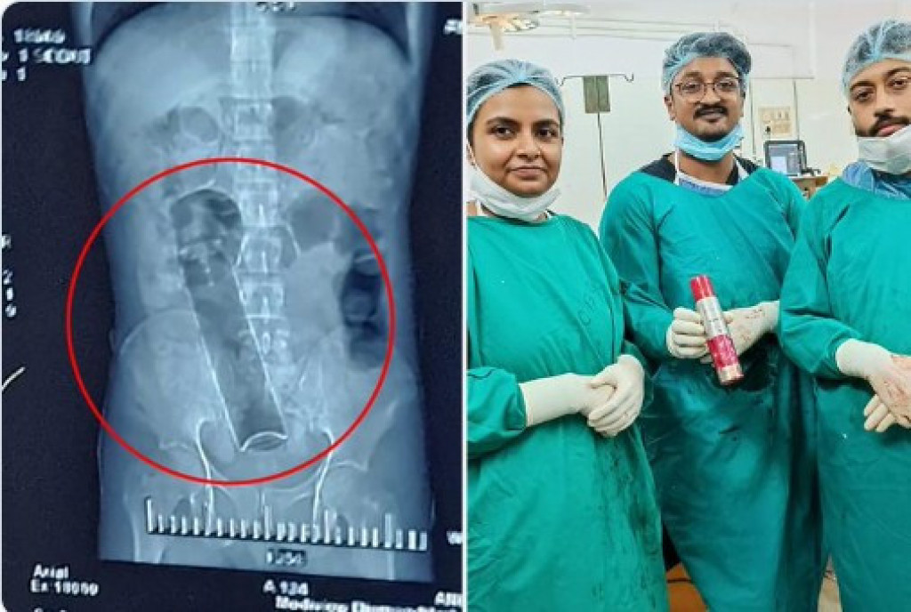 Dvadeset dana nije vršio NUŽDU: Primljen je u HITNU, a hirurzi su se frapirali kad su ga operisali (FOTO)