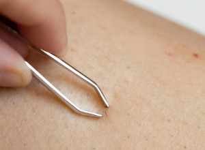 Četiri meseca bio u KOMI, a ŠEST sati je trajala OPERACIJA: Urasla dlaka ga umalo KOŠTALA ŽIVOTA, a evo kada je SMRTONOSNA