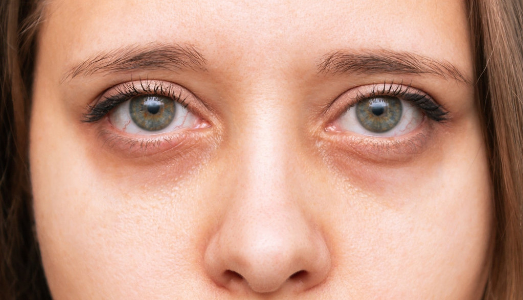 Povišen holesterol se vidi u očima: Dr Bajić upozorava kako da uočite prve simptome bolesti koju zovu i "tihi ubica"