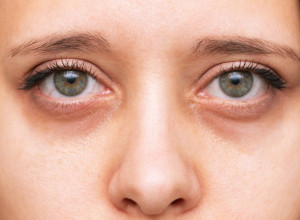 Ako primetite ovu promenu na kapcima, odmah se javite lekaru: Koža bez greške otkriva da li ste u riziku da dobijete ovu bolest