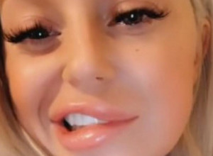 Otišla na estetski zahvat, vratila se sa ISKRIVLJENIM licem: Devojka podelila svoju muku, isto se desilo i Anđelini Džoli! (VIDEO)