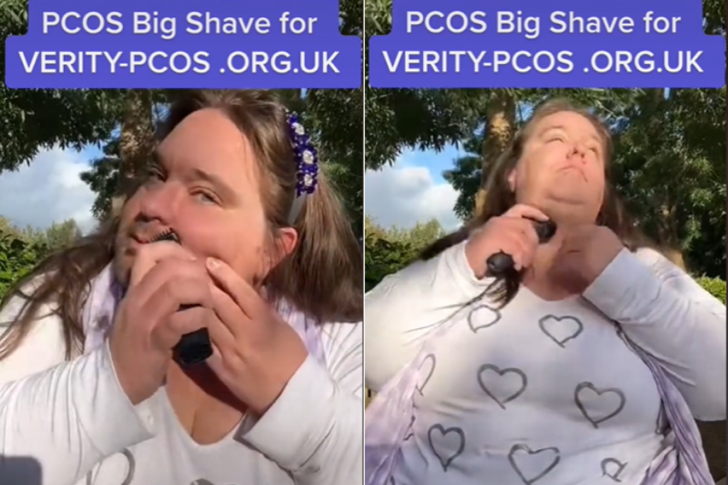 Dva meseca je puštala BRADU kako bi skrenula pažnju na BOLEST sa kojom se bori svaka peta ŽENA (VIDEO)