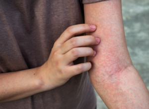 Julijani se pojavio osip i mislila je da je bezazlen: Bio je to simptom opasne bolesti, minuti su je delili od smrti