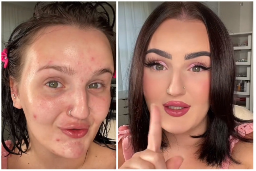 Hiljade žena gleda ZABEZEKNUTO u ovaj VIDEO: Devojka je JEDNOSTAVNIM trikom uspela da prekrije SVE BUBULJICE