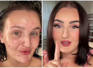 Hiljade žena gleda ZABEZEKNUTO u ovaj VIDEO: Devojka je JEDNOSTAVNIM trikom uspela da prekrije SVE BUBULJICE