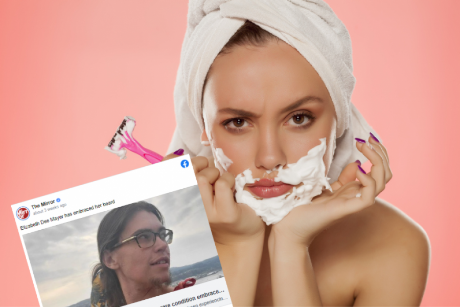 Žene koje pate od ove bolesti skrivaju svoje lice: Elizabeta sa PONOSOM pokazuje simptome retkog poremećaja