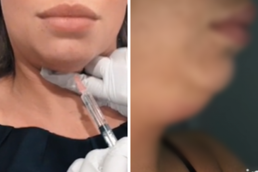 Deniz posle zahvata estetske medicine izgleda "KAO ŽABA": Dečko se UPLAŠIO kada me je video