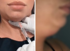 Deniz posle zahvata estetske medicine izgleda "KAO ŽABA": Dečko se UPLAŠIO kada me je video