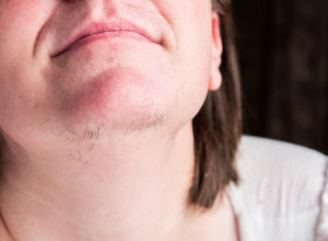 Šta dlačice na bradi govore o zdravlju žene? Umesto da ih čupate, idite brzo kod lekara