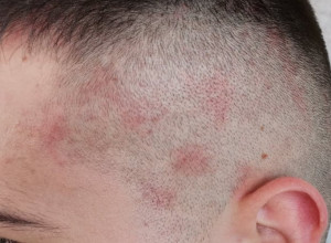 Ermin se tuširao TRI PUTA dnevno i evo šta se desilo sa njegovom KOŽOM: Danas trećinu plate troši na kreme i lekove