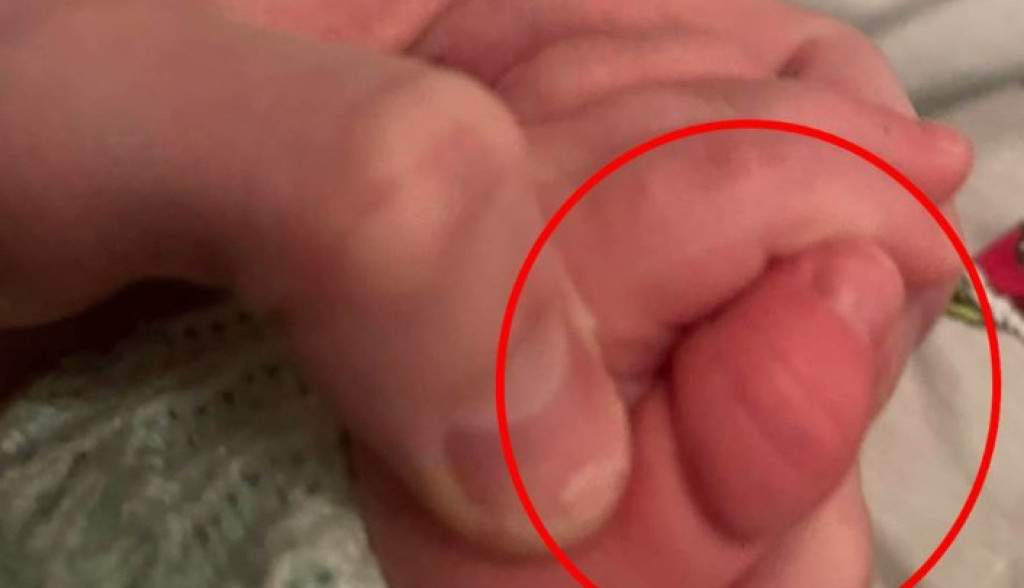 Beba umalo ostala BEZ PRSTA zbog IGRAČKE: "Zaspala je, a onda sam čula jak PLAČ", mama podelila fotografije i UPOZORILA
