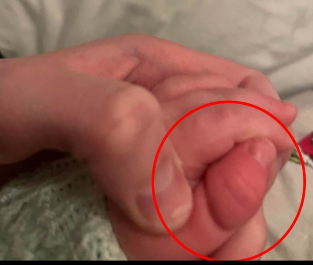 Beba umalo ostala BEZ PRSTA zbog IGRAČKE: "Zaspala je, a onda sam čula jak PLAČ", mama podelila fotografije i UPOZORILA
