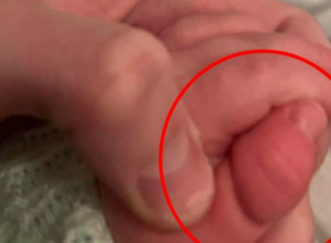 Beba umalo ostala BEZ PRSTA zbog IGRAČKE: "Zaspala je, a onda sam čula jak PLAČ", mama podelila fotografije i UPOZORILA