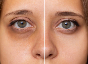 Uz pomoć ovog voća ona se rešila podočnjaka: Dovoljno je da stavite dve kriške ispod očiju, a sa ovim uljem možete da napravite masku