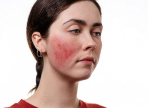 Nataliju su zbog bolesti zvali "PARADAJZ" i maltretirali od malih nogu: "Bila sam dugo u depresiji, a onda sam pronašla lek"