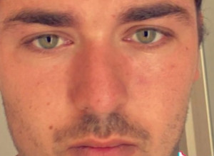 Zaspao je sa sočivima i oslepeo: Bakterija mu je bukvalno "pojela" oko, a sve zbog bezazlene greške koju svi često pravimo