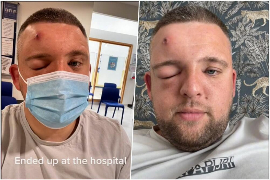 Iz čela su mu izvadili nešto što se MIGOLJI: Mladić danima CEDIO bubuljicu, a onda je zaglavio u BOLNICI