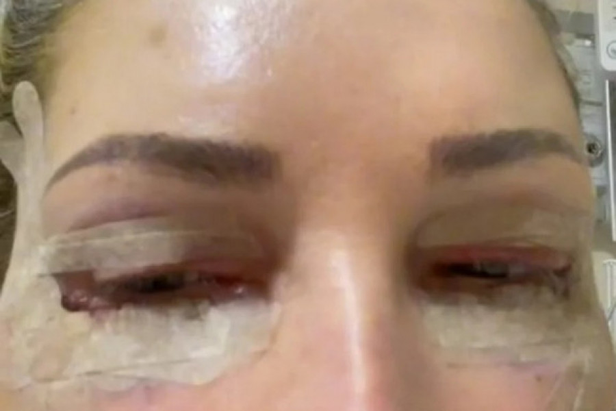 Nina (65) odlučila se za PLASTIČNU operaciju u Turskoj: Žena je sada pokazala šta ju je zadesilo (VIDEO)