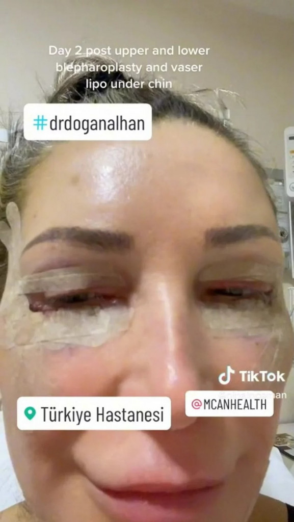 Nina (65) odlučila se za PLASTIČNU operaciju u Turskoj: Žena je sada pokazala šta ju je zadesilo (VIDEO)